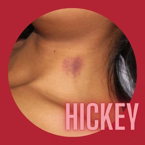 Can Black People Get Hickeys