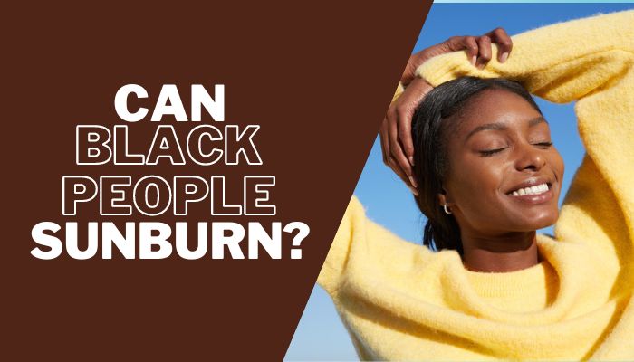 Can Black People Get Sunburn? Everything You Need to Know!