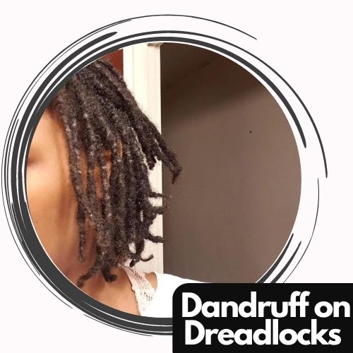 Dandruff on Dreadlocks